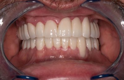 After treatment
