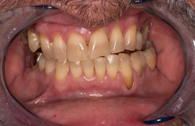Before treatment
