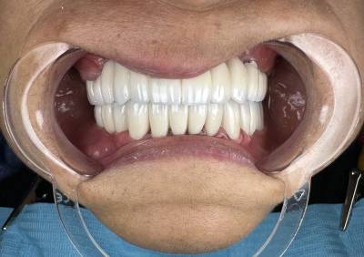 After treatment