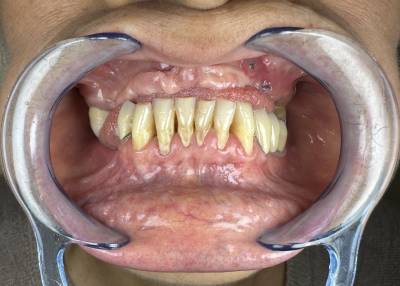 Before treatment