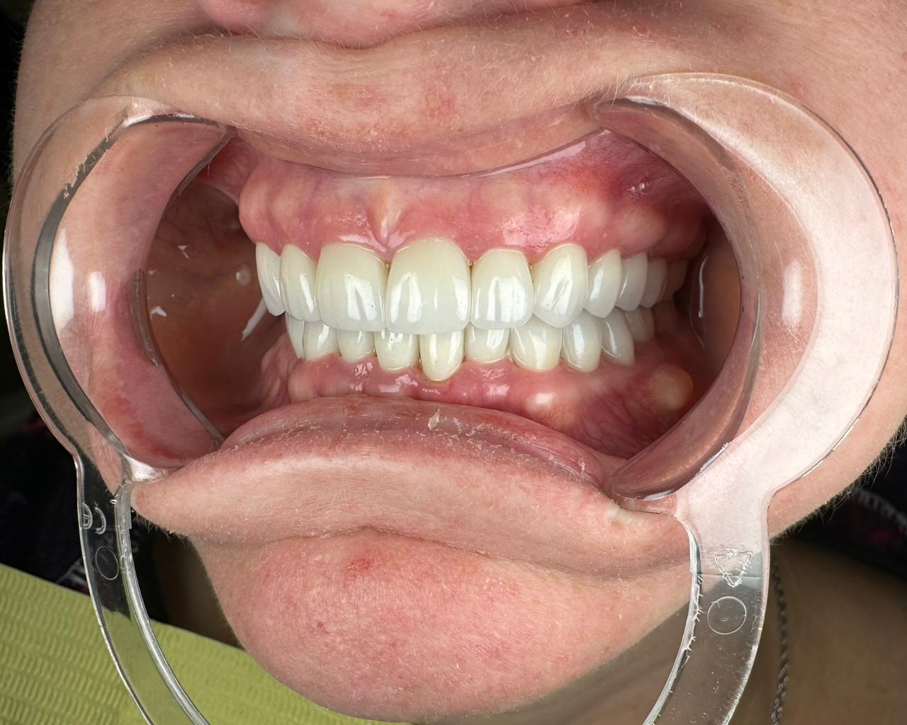 After treatment