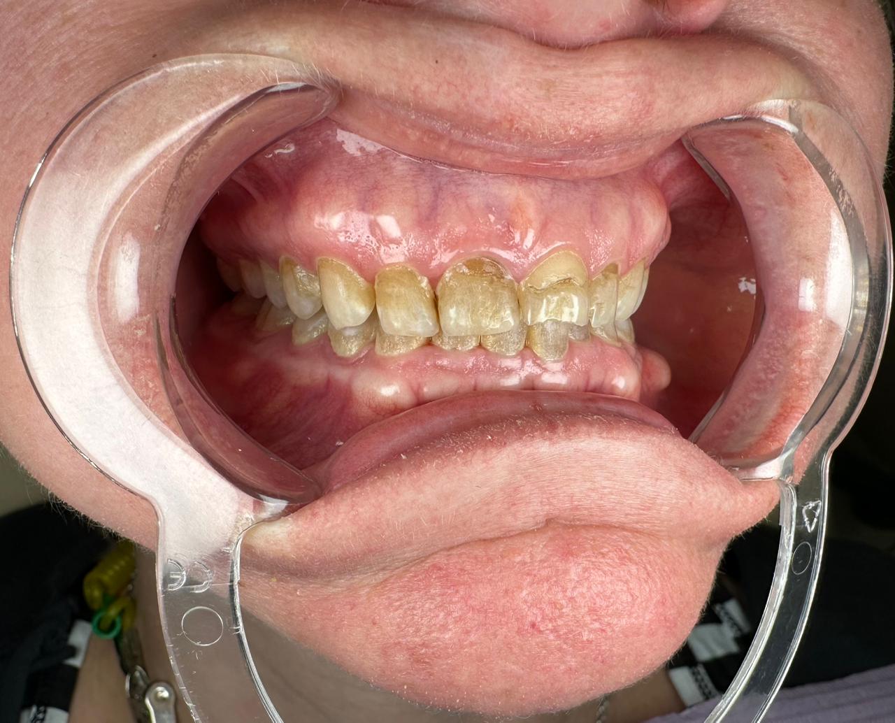 Before treatment