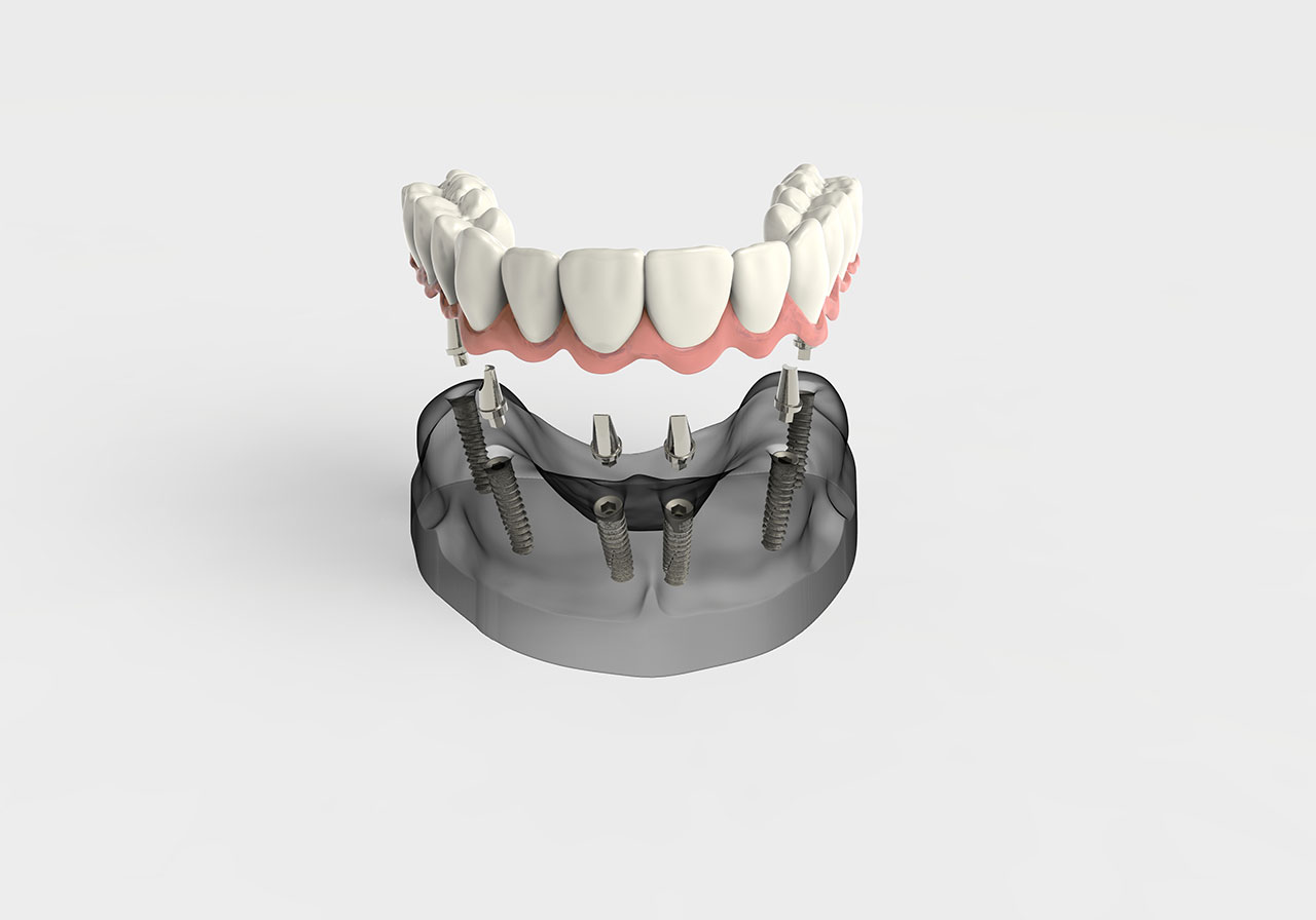 Full Mouth Restoration