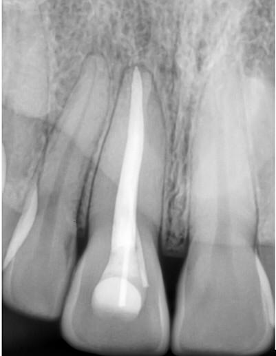 Root Canal