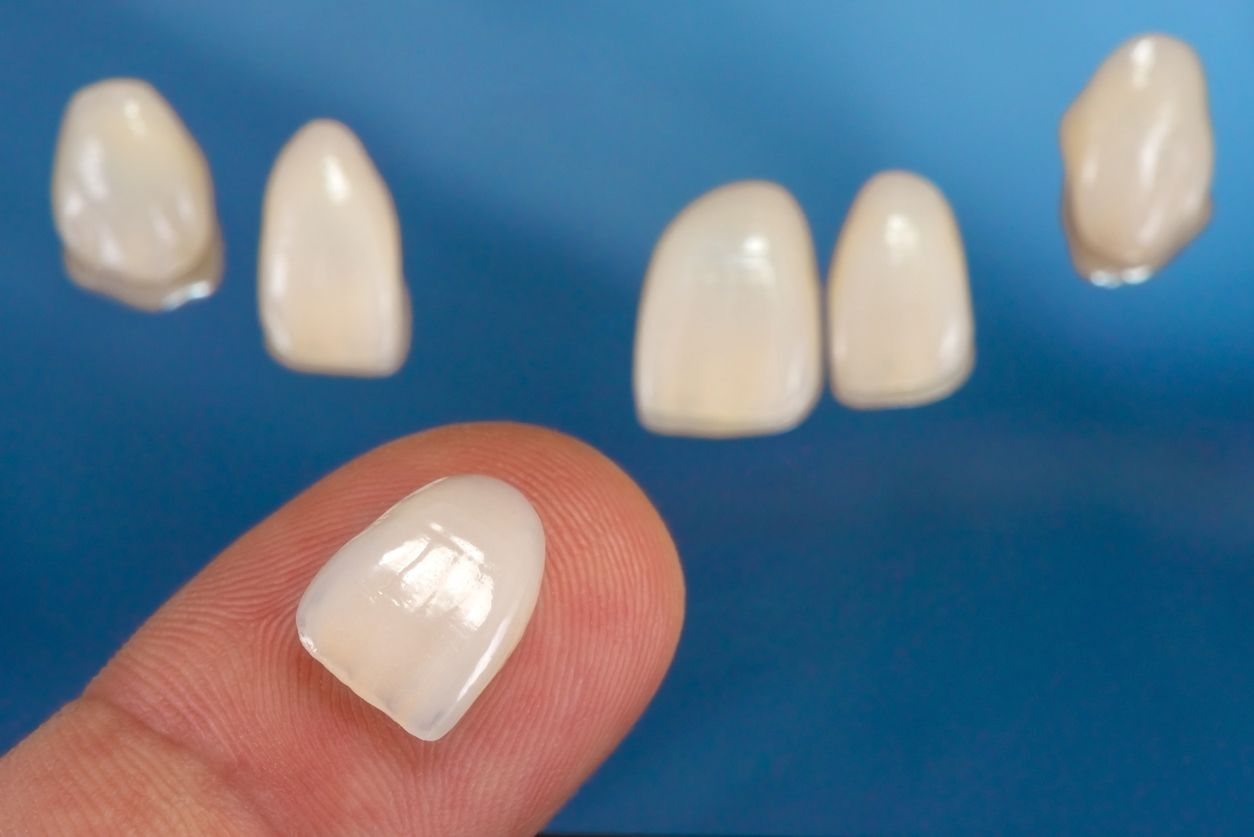 Veneers