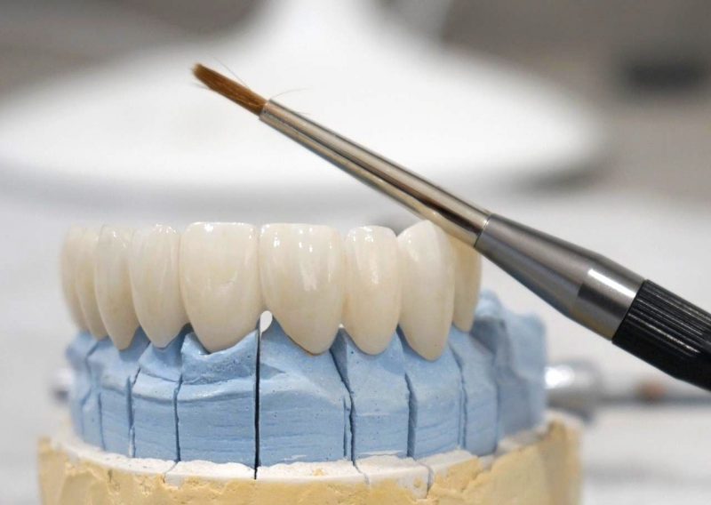 Dental Crowns Dental Crowns