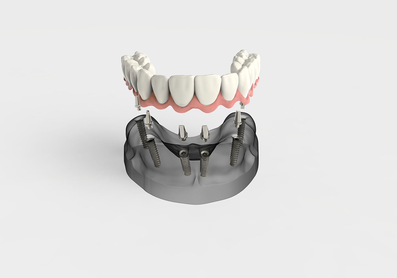 Dental Full Mouth Restoration